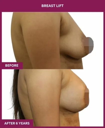2 breast lift (2)