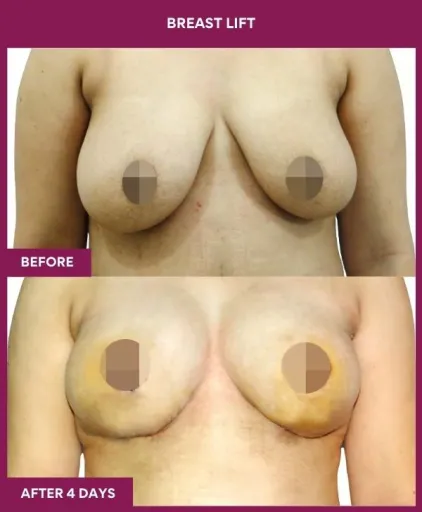 3 breast lift
