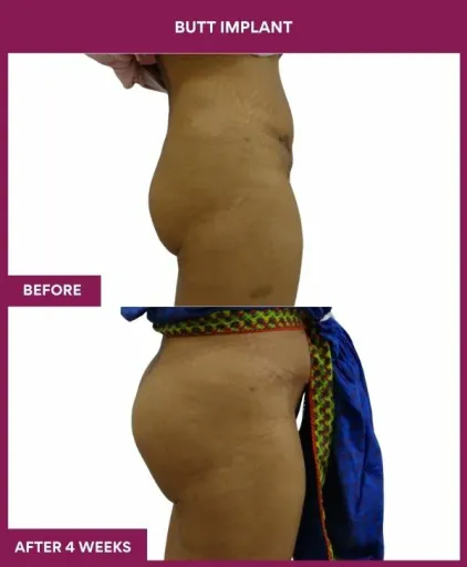 4 BUTT implant (2)