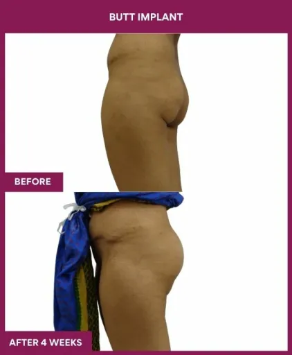 4 BUTT implant (3)