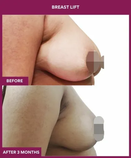 4 breast lift (2)