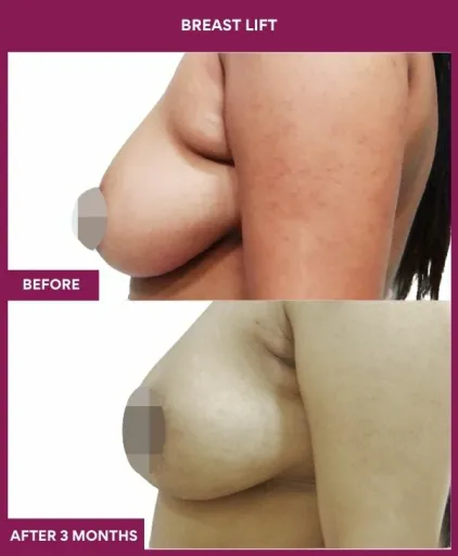 4 breast lift (3)