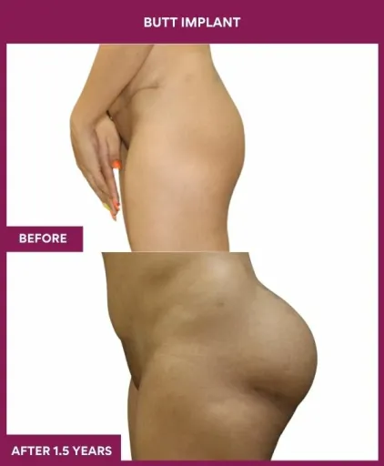 7 BUTT implant (2)
