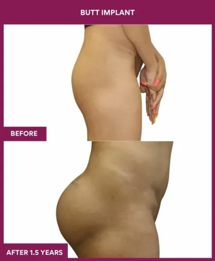 7 BUTT implant (3)