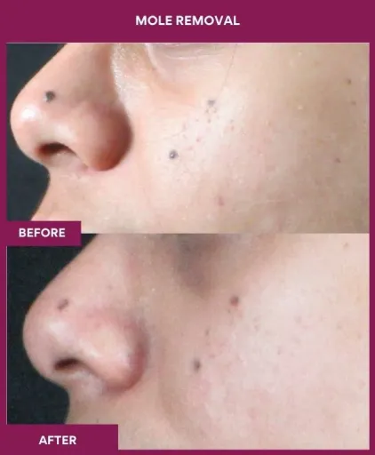 7 Mole Removal (2)