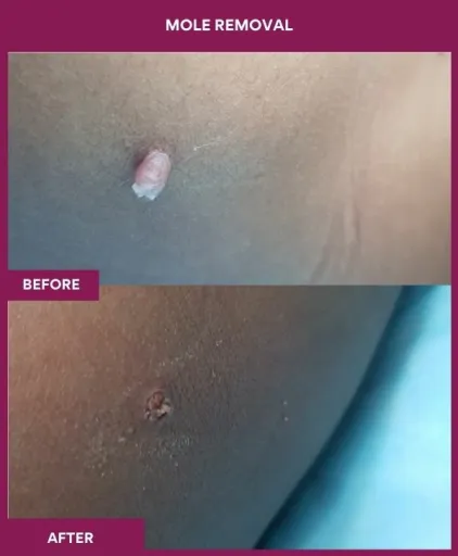 8 Mole Removal