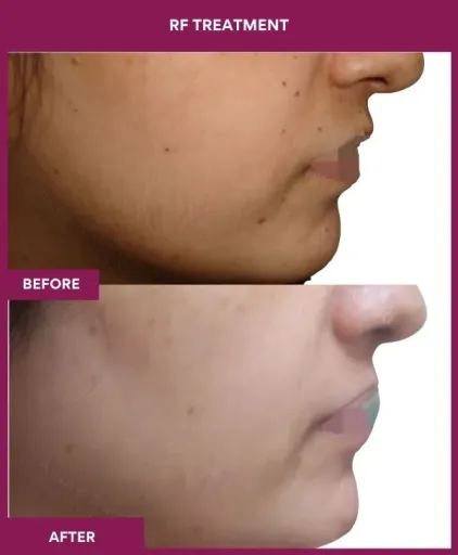 RF Treatment (2)_3