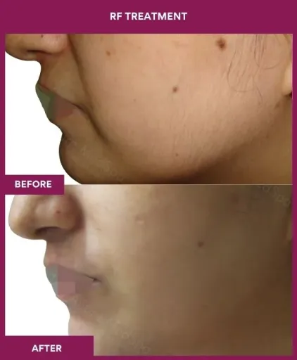 RF Treatment (3)_3