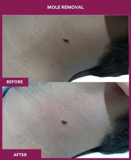 mole Removal (3)