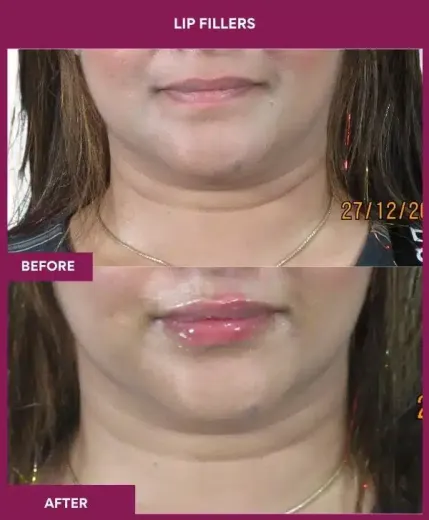 Lip filler treatment before and after results in Mumbai by Dr Milan Doshi – front view