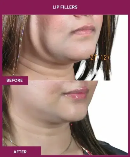 Lip augmentation results by Dr Milan Doshi in Mumbai – right profile view