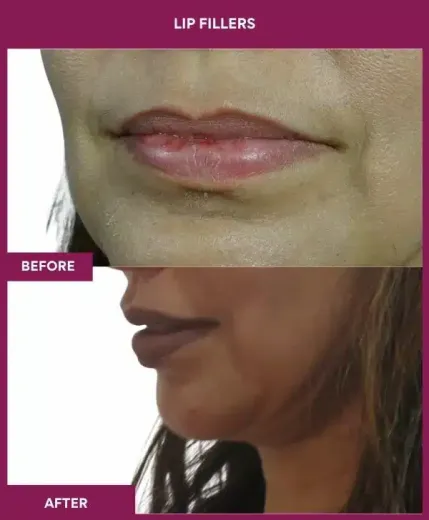 Natural lip filler results in Mumbai – left side profile by Dr Milan Doshi