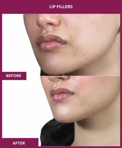 Before and after lip filler enhancement Mumbai – left profile view