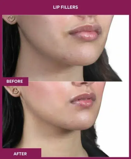 Lip augmentation procedure by Dr Milan Doshi Mumbai – right profile