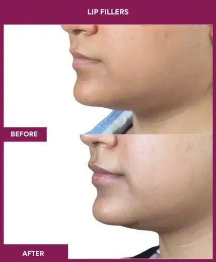 Before and after lip augmentation Mumbai aesthetic clinic – left profile