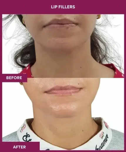 Lip filler results by Dr Milan Doshi Mumbai aesthetic clinic – front view