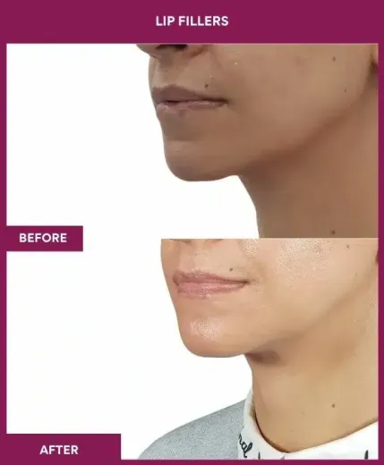 Lip volume enhancement before after Mumbai – left side profile