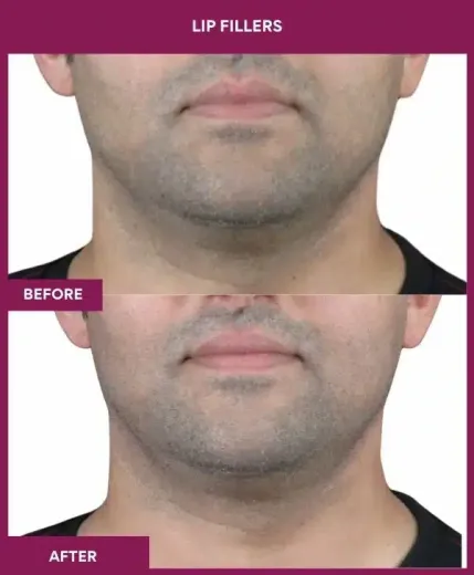 Lip augmentation results in Mumbai by Dr Milan Doshi – front view