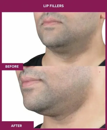 Lip filler treatment before after Mumbai aesthetic clinic – left profile