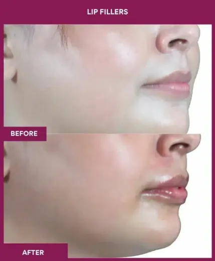 Cosmetic lip filler results by Dr Milan Doshi – right view