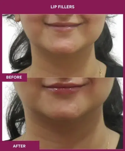 Lip filler aesthetic results in Mumbai by Dr Milan Doshi – front view