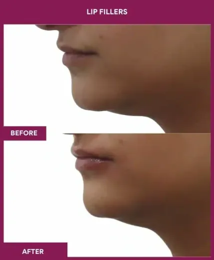 Lip volume correction with fillers Mumbai – left profile