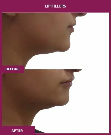 Lip filler enhancement results by Dr Milan Doshi – right view