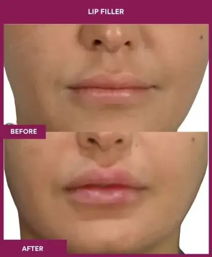Lip augmentation before and after results Mumbai clinic – front view