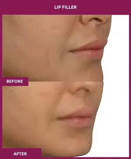 Natural lip filler enhancement Mumbai – right profile