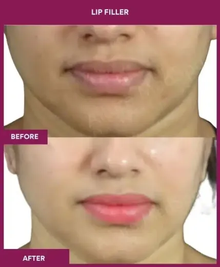 Lip filler cosmetic results Mumbai by Dr Milan Doshi – front view