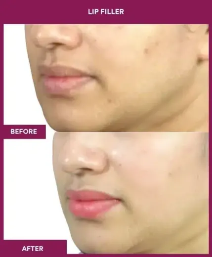 Before after lip filler enhancement Mumbai – left side profile