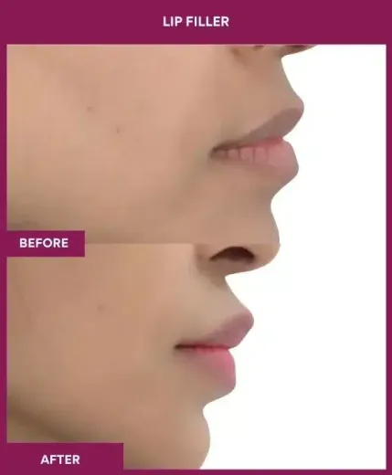 Lip filler enhancement by Dr Milan Doshi – right profile