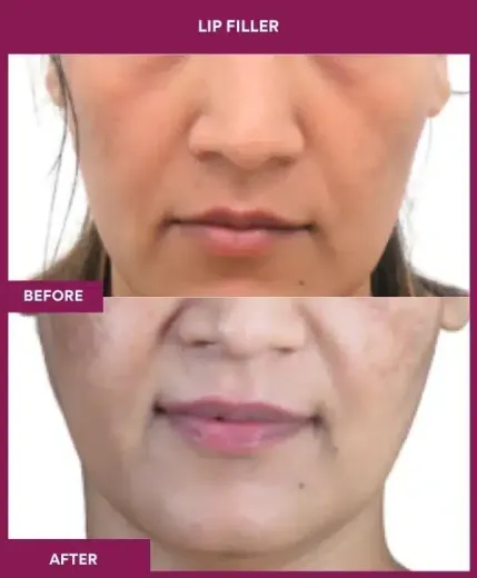 Lip filler before after results Mumbai by Dr Milan Doshi – front view