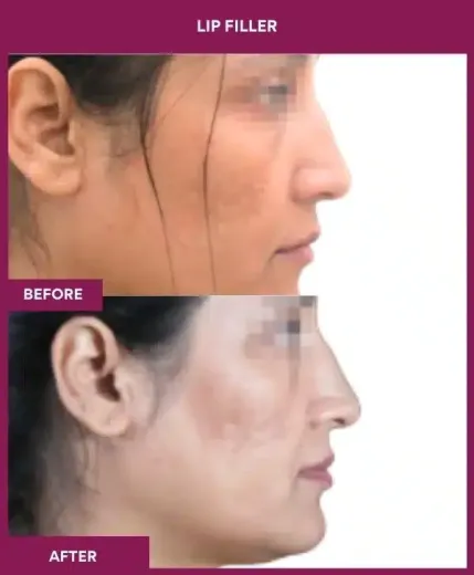 Lip augmentation results by Dr Milan Doshi – right profile