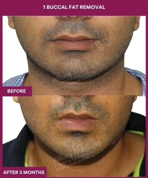 1 Buccal Fat Removal (3)_1