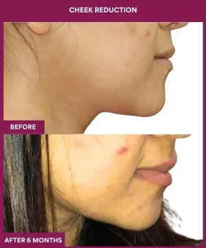 1 Cheek Reduction (1)_