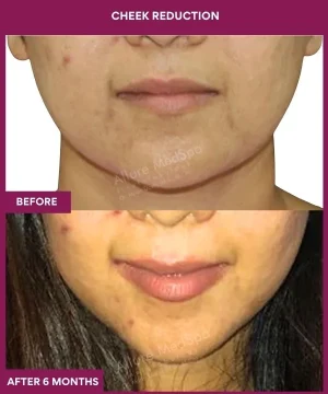 1 Cheek Reduction (3)_