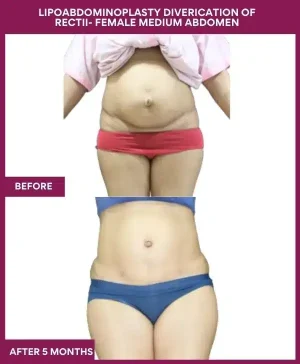 1 LIPOABDOMINOPLASTY DIVERICATION OF RECTII- FEMALE MEDIUM ABDOMEN_3_ (1)