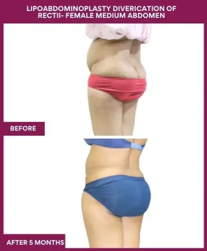 1 LIPOABDOMINOPLASTY DIVERICATION OF RECTII- FEMALE MEDIUM ABDOMEN_3_ (3)