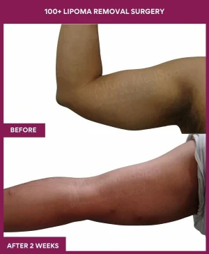 10 100+ Lipoma Removal Surgery (2)