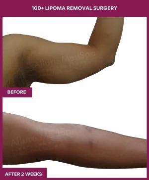 10 100+ Lipoma Removal Surgery