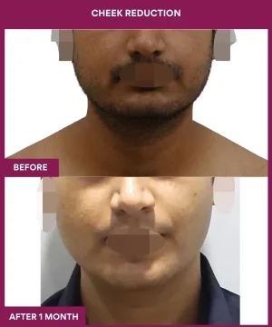 10 Cheek Reduction_28_