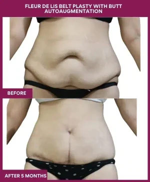 10 Fleur de lis Belt plasty with butt autoaugmentation_ (1)