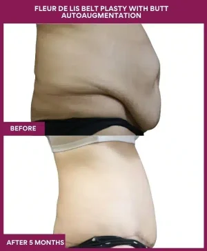 10 Fleur de lis Belt plasty with butt autoaugmentation_ (3)