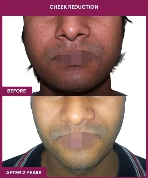 11 Cheek Reduction_30_