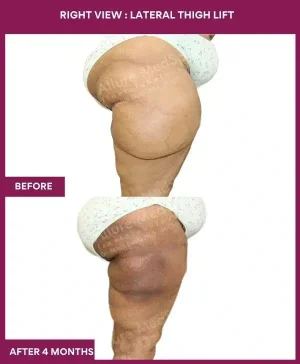 11 Right View Lateral Thigh Lift-