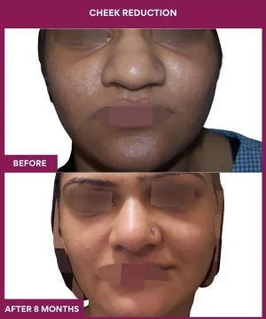 16 Cheek Reduction_35_