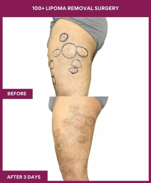 2 100+ Lipoma Removal Surgery (3)