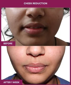 2 Cheek Reduction_7_