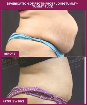 2 DIVERICATION OF RECTII-PROTRUDINGTUMMY- TUMMY TUCK_6_ (7)